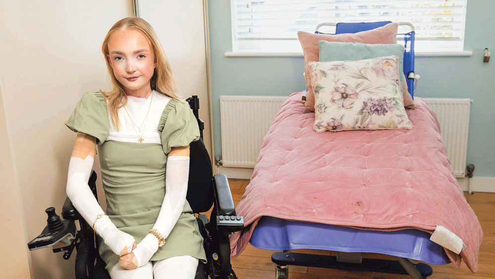 EB sufferer never wants anyone to experience her loneliness EB sufferer never wants anyone to experience her loneliness